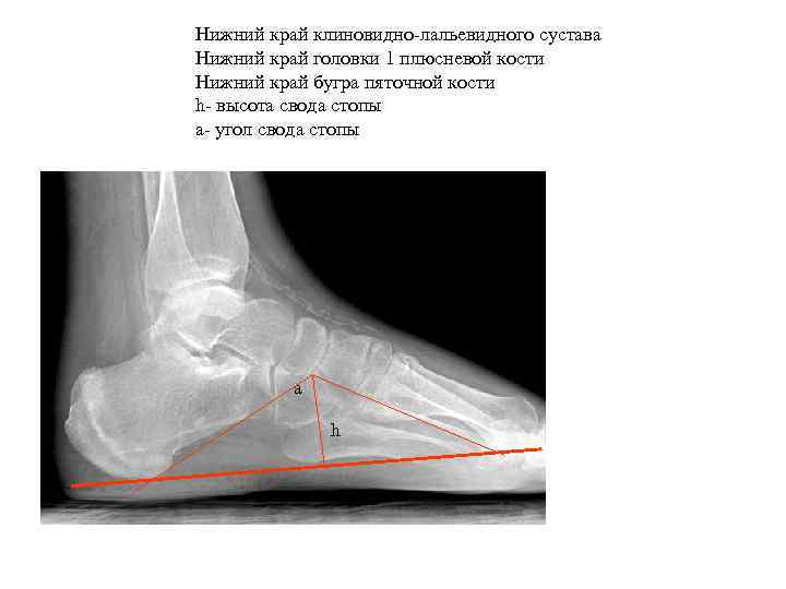 Нижний край клиновидно-лальевидного сустава Нижний край головки 1 плюсневой кости Нижний край бугра пяточной