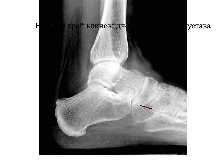Нижний край клиновидно-ладьевидного сустава 