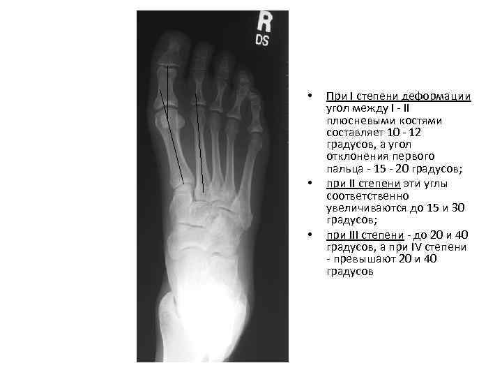  • • • При I степени деформации угол между I - II плюсневыми