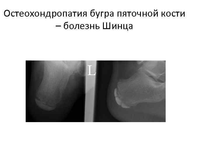 Остеохондропатия бугра пяточной кости – болезнь Шинца 