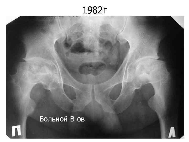 1982 г Больной В-ов 