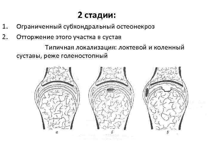 Субхондральная перестройка