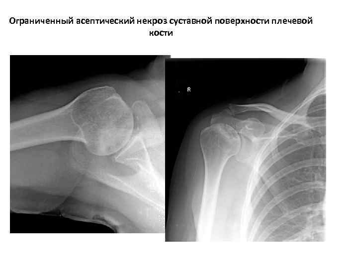 Некроз кости. Некроз плечевого сустава рентген. Асептический некроз плечевого сустава. Асептический некроз плечевой кости. Асептический некроз лучевой кости.