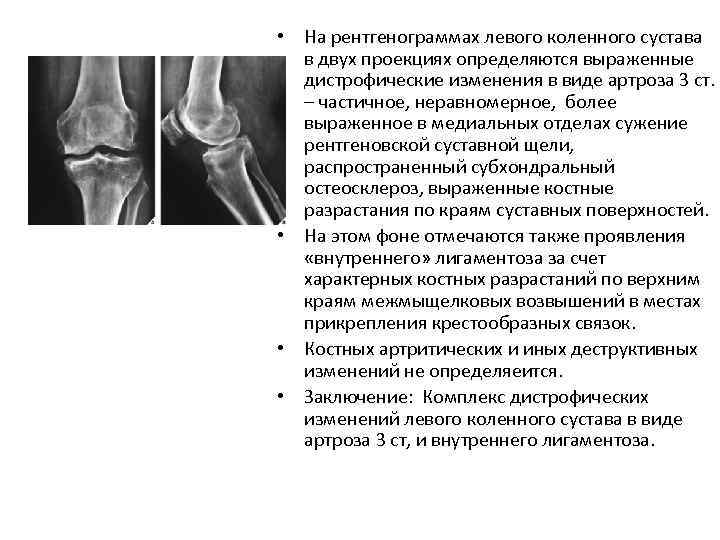 Тэп сустава. Коленный сустав рентген норма. Гонартроз коленного сустава описание рентгена. Рентгенография коленного сустава описание. Рентген коленного сустава заключение.