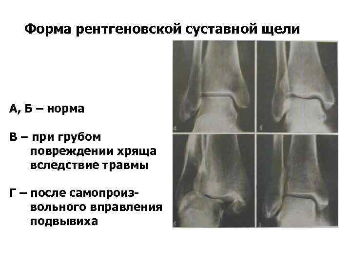 Форма рентгеновской суставной щели А, Б – норма В – при грубом повреждении хряща