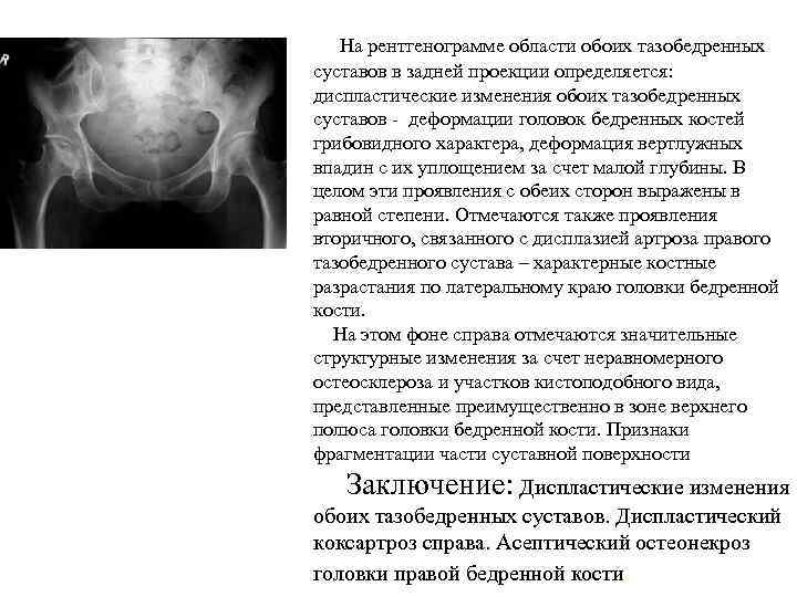 Изменения обоих. Протокол описания кт тазобедренных суставов. Грибовидная деформация головки бедренной кости справа протокол. Дистрофические изменения головок бедренных костей. Грибовидная деформация головки бедренной.