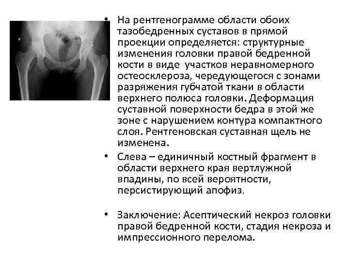 Асептический некроз бедренной кости. Асептический некроз головки бедренной кости рентген протокол. Асептический некроз головки бедренной кости рентген описание. Асептический некроз стадии кт. Асептический некроз головки бедренной рентген описание.