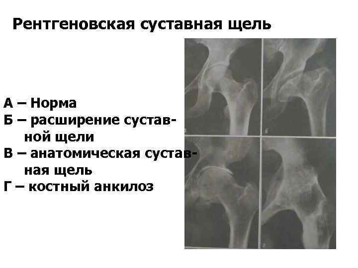 Рентгенологическая картина костного анкилоза внчс характеризуется