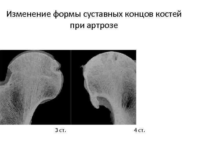 Изменение формы суставных концов костей при артрозе 3 ст. 4 ст. 