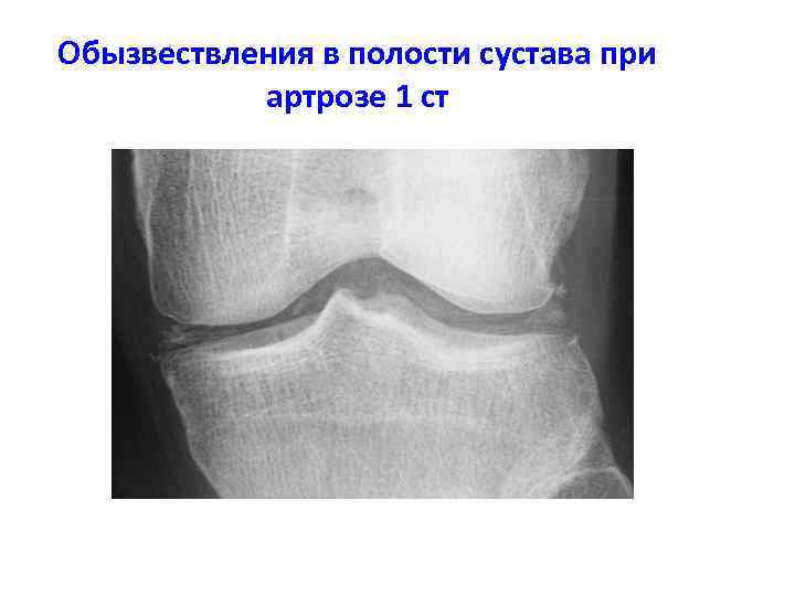 Обызвествление. Обызвествление менисков коленного сустава рентген. Обызвествление связки надколенника. Обызвествление связок надколенника рентген. Обызвествление связок коленного сустава на рентгене.