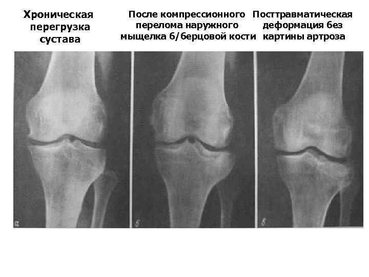 Перелом мыщелка форум