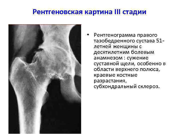 В каких случаях показана компьютерная рентгеновская томография пораженного сустава тест