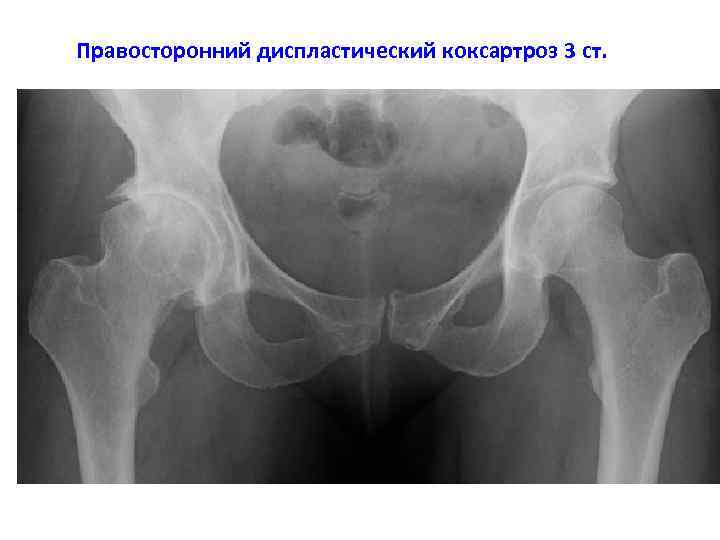 Правосторонний диспластический коксартроз 3 ст. 