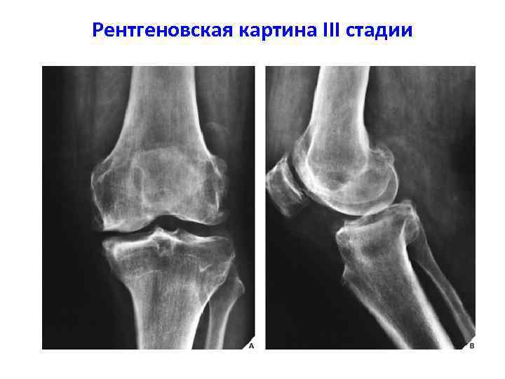 Субхондральный склероз голеностопного. Кистовидная перестройка надмыщелка бедренной кости. Кистовидная перестройка костной ткани. Кистовидная перестройка костной ткани тазобедренного сустава.