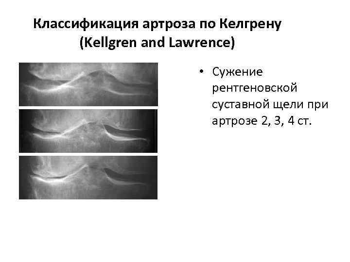 Классификация артроза по Келгрену (Kellgren and Lawrence) • Сужение рентгеновской суставной щели при артрозе