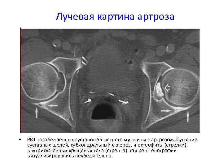 Склероз суставных поверхностей