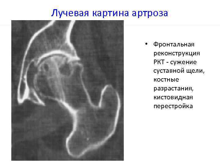 Лучевая картина при вывихах внчс