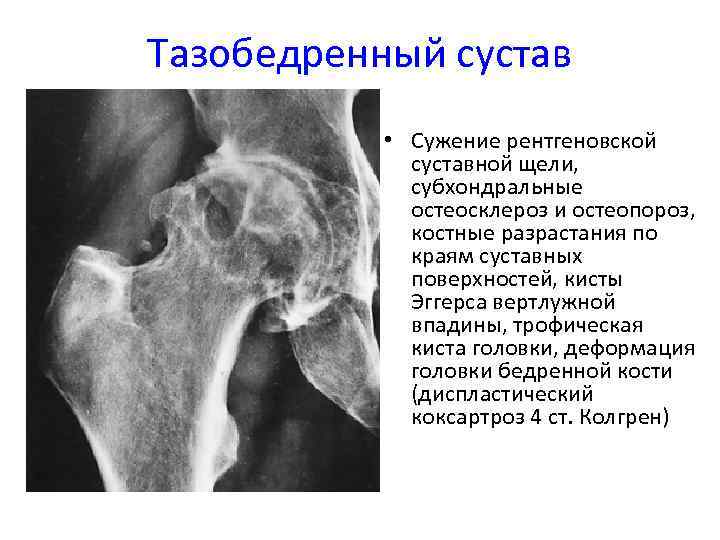 Склероз и краевые остеофиты. Что такое дефартроз тазобедренного сустава. Головка бедренной кости рентген. Киста Эггерса вертлужной впадины. Остеосклероз тазобедренного сустава рентген.