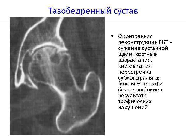 Единичное кистовидное просветление. Киста Эггерса вертлужной впадины. Кистовидная перестройка костной структуры тазобедренного сустава. Кистозная перестройка тазобедренного сустава. Кисты вертлужной впадины кт.