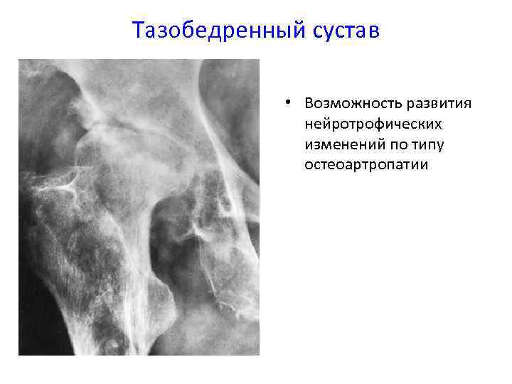 Тазобедренный сустав • Возможность развития нейротрофических изменений по типу остеоартропатии 