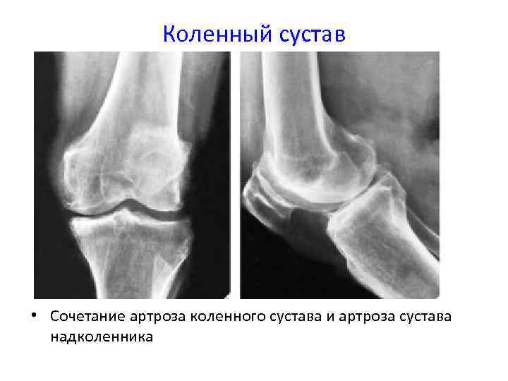 Коленный сустав • Сочетание артроза коленного сустава и артроза сустава надколенника 