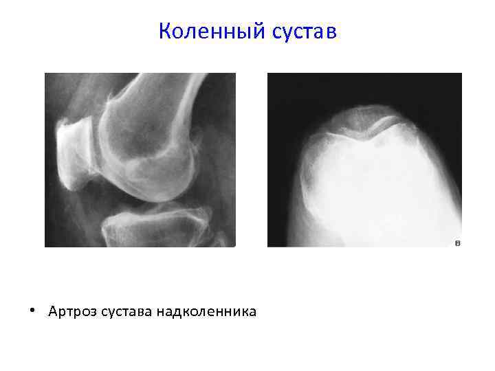 Коленный сустав • Артроз сустава надколенника 