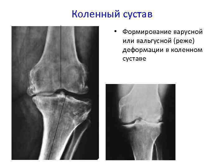 Вальгусная деформация коленных суставов фото