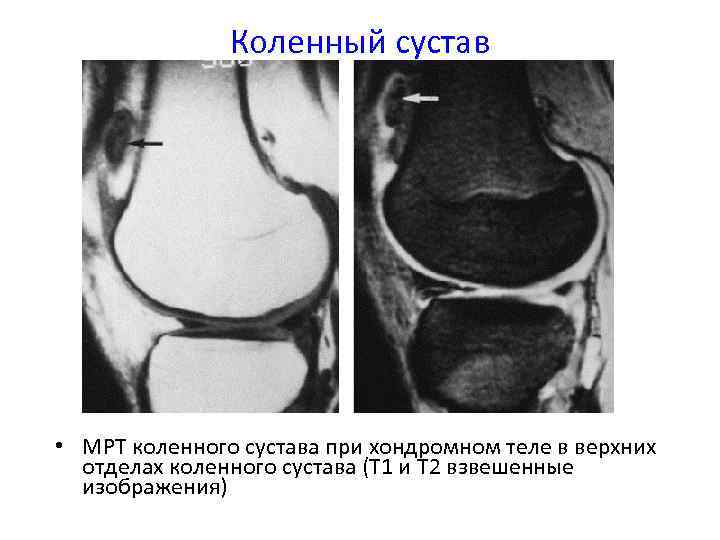 Мрт суставов тела. Хондральное тело в коленном суставе мрт. Хондромное тело в коленном суставе мрт.