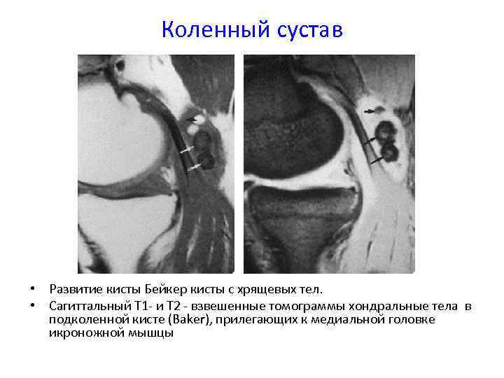 Коленный сустав • Развитие кисты Бейкер кисты с хрящевых тел. • Сагиттальный Т 1