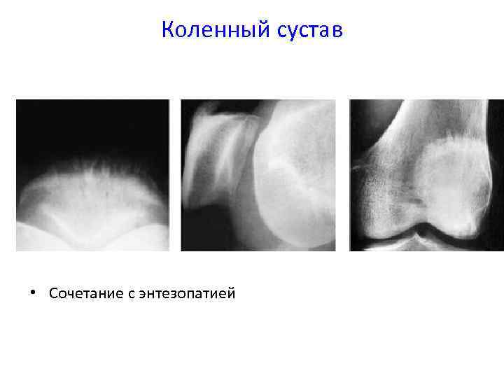 Энтезопатия что это такое. Энтезопатия надколенника. Энтезопатия коленного сустава рентген.