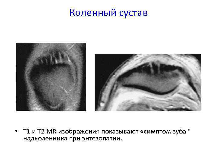 Коленный сустав • Т 1 и T 2 MR изображения показывают «симптом зуба 