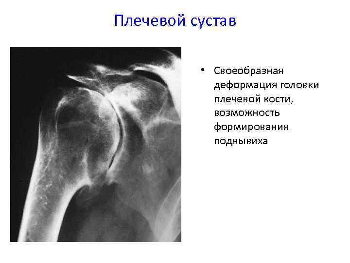 Кистовидное головки плечевой кости