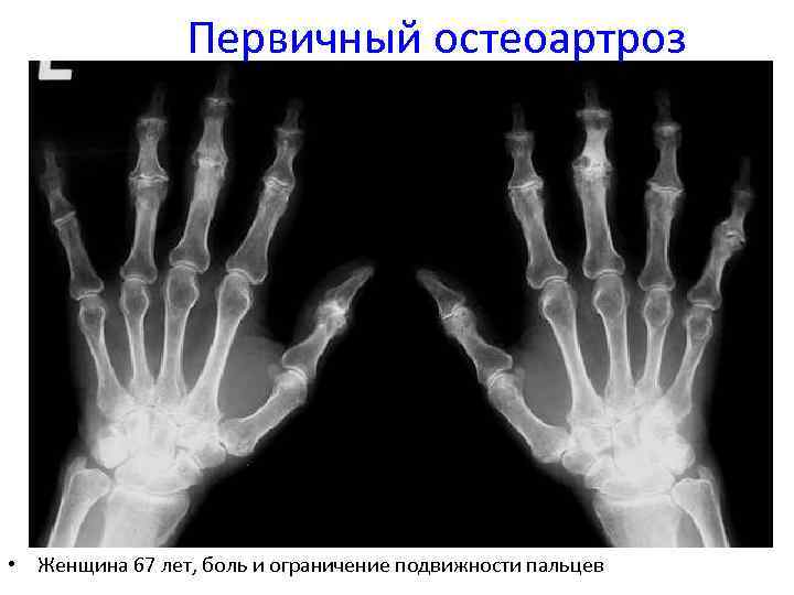 Первичный остеоартроз • Женщина 67 лет, боль и ограничение подвижности пальцев 