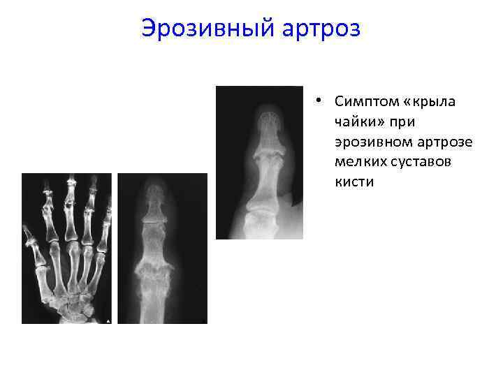 Эрозивный артроз • Симптом «крыла чайки» при эрозивном артрозе мелких суставов кисти 