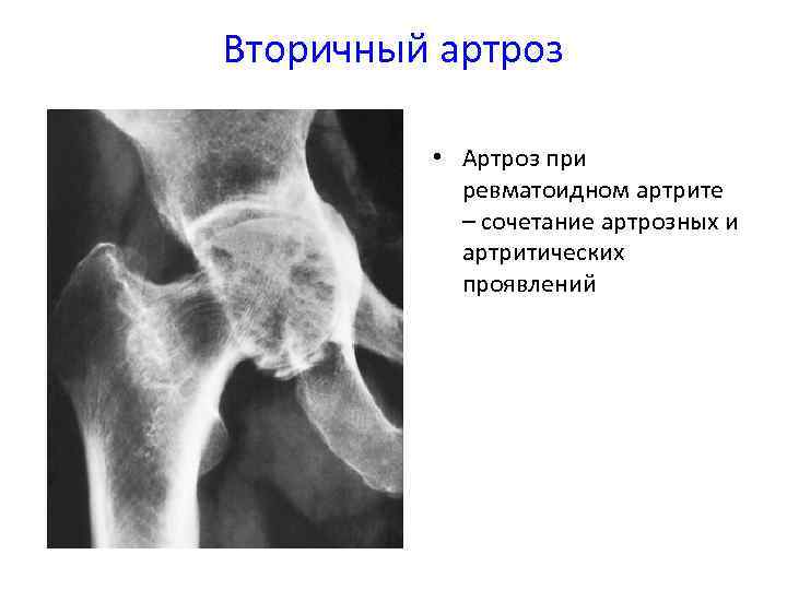 Единичное кистовидное просветление. Кистовидная перестройка головки бедренной кости. Кистовидная перестройка костей. Кистовидная перестройка костной ткани коленного сустава. Кистовидная перестройка головки плечевой кости.