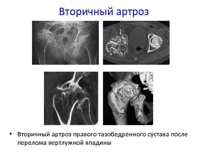 Вторичный артроз • Вторичный артроз правого тазобедренного сустава после перелома вертлужной впадины 