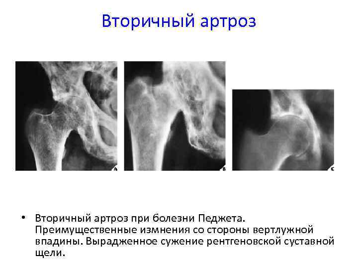 Остеофиты вертлужной впадины