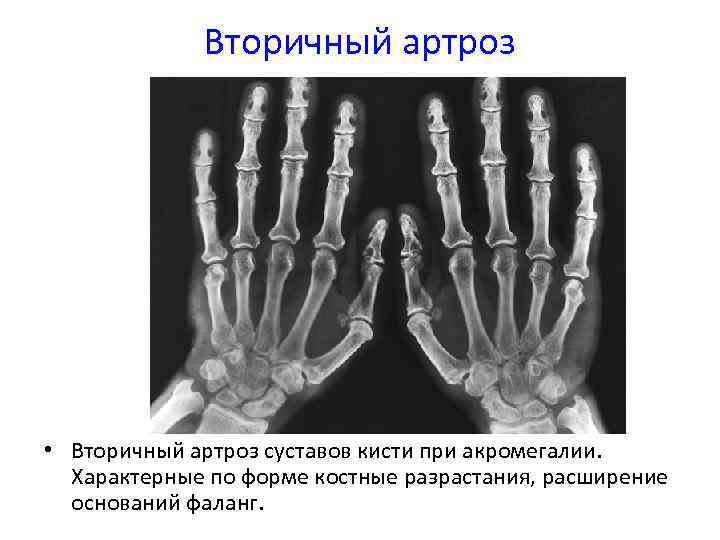 Вторичный артроз • Вторичный артроз суставов кисти при акромегалии. Характерные по форме костные разрастания,