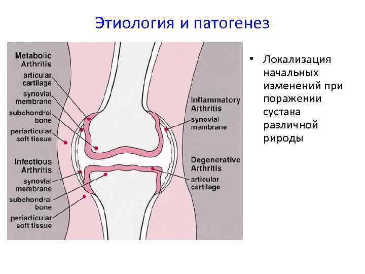 Этиология и патогенез • Локализация начальных изменений при поражении сустава различной рироды 