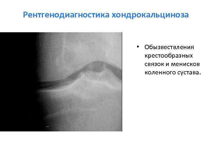 Обызвествление. Обызвествления в коленном суставе на рентгене. Хондрокальциноз коленного сустава рентген. Обызвествление крестообразной связки рентген. Обызвествление менисков рентген.