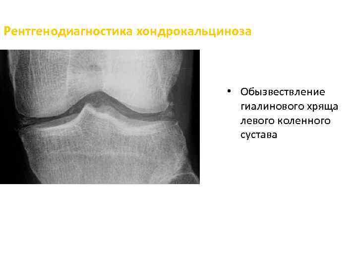 Рентгенодиагностика хондрокальциноза • Обызвествление гиалинового хряща левого коленного сустава 