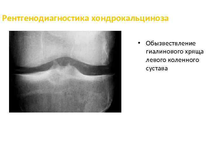 Обызвествление. Хондрокальциноз коленного сустава рентген. Хондрокальциноз менисков. Обызвествление менисков рентген. Хондрокальциноз коленного сустава мрт.