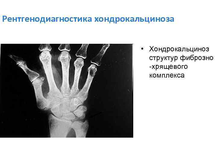 Рентгенодиагностика хондрокальциноза • Хондрокальциноз структур фиброзно -хрящевого комплекса 