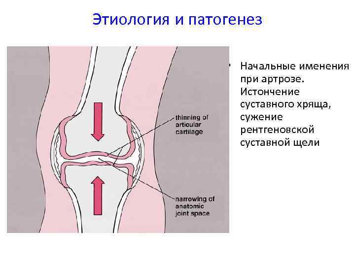 Этиология и патогенез • Начальные именения при артрозе. Истончение суставного хряща, сужение рентгеновской суставной