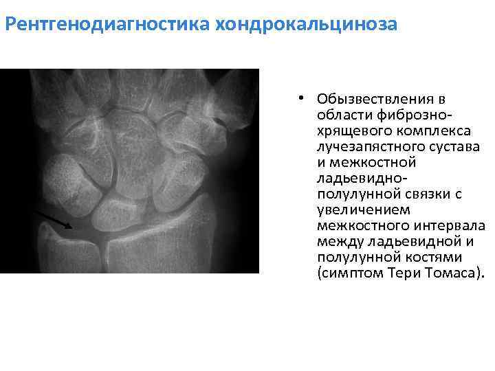 Обызвествление. Хондрокальциноз лучезапястного сустава. Хондрокальциноз коленного сустава рентген. Обызвествление в суставе. Обызвествление суставного хряща.
