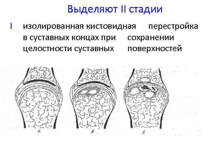 Единичное кистовидное просветление. Кистовидная перестройка костной структуры головки бедренной кости. Кистовидная перестройка мыщелка бедренной кости. Кистовидная перестройка коленного сустава. Кистовидные просветления в коленном суставе.