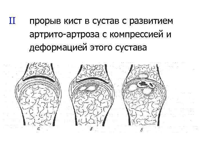 II прорыв кист в сустав с развитием артрито-артроза с компрессией и деформацией этого сустава