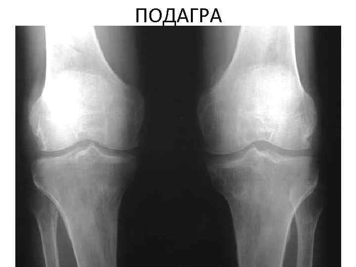 Подагра коленного сустава. Подагра коленного сустава рентген. Подагрический артрит коленного сустава рентген. Ревматоидный артрит коленного сустава рентген. Артрит подагрический коленный рентген.