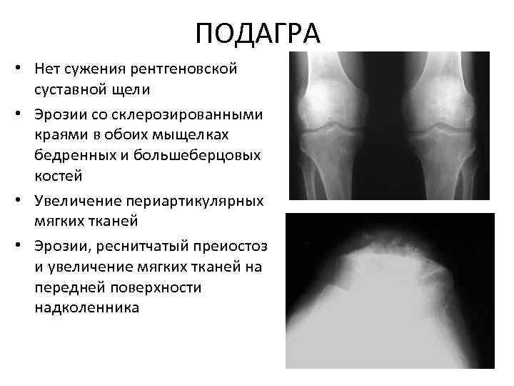 ПОДАГРА • Нет сужения рентгеновской суставной щели • Эрозии со склерозированными краями в обоих