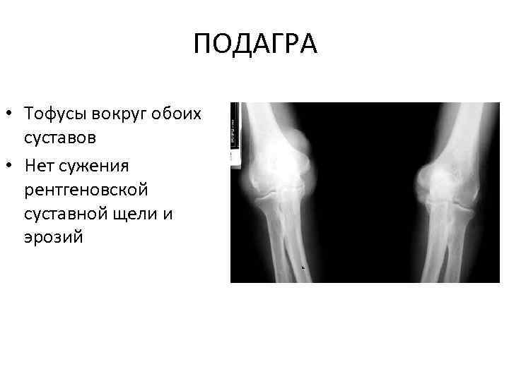 Подагрический артрит картинки